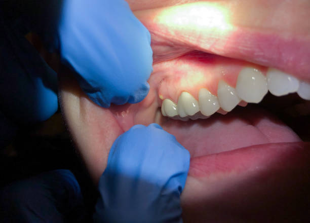 Best Emergency Treatment for Toothache in Marion, KS